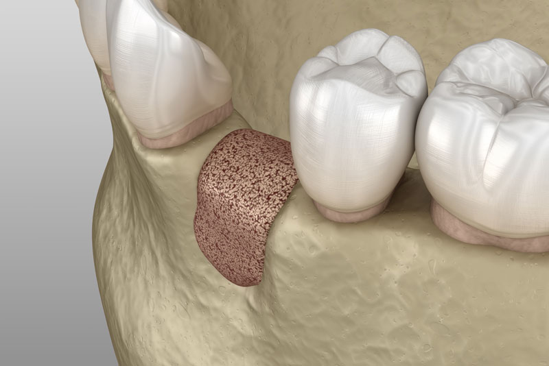 bone graft model