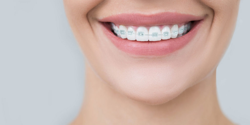 braces patient smiling